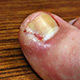 Infection ingrown toenail